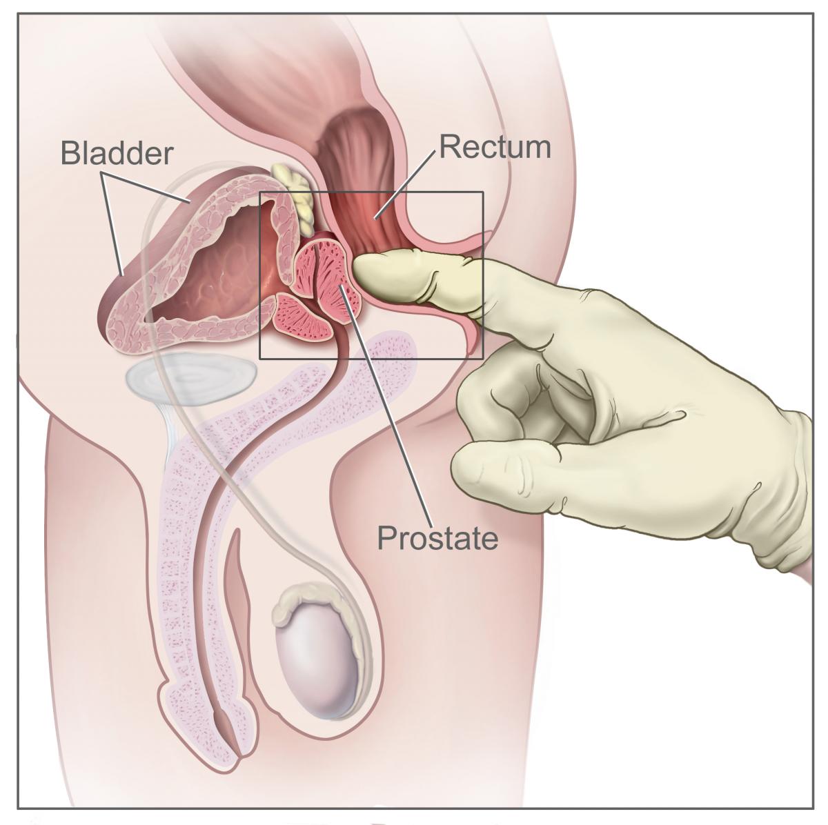 prostate cancer 01.jpg